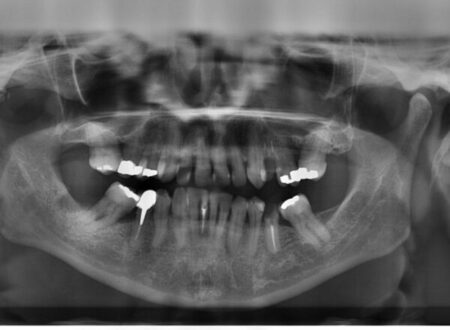 restorative radiopacifer dental composite